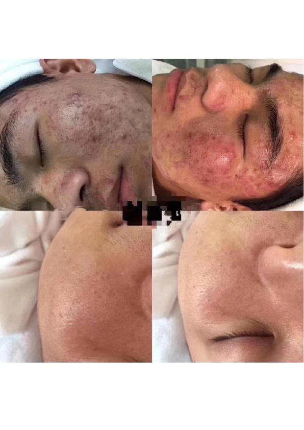 炎症性痤疮阶段对比