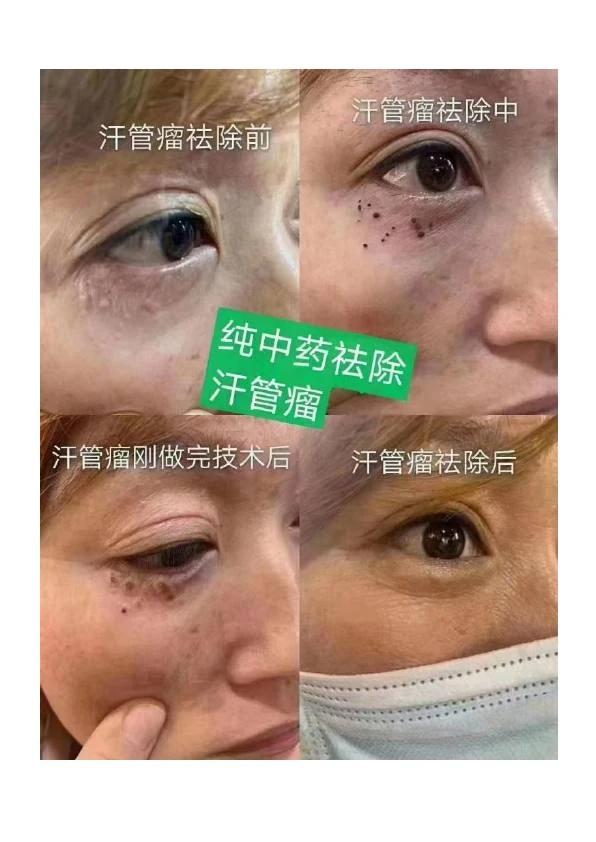 眼周睑黄疣改善对比