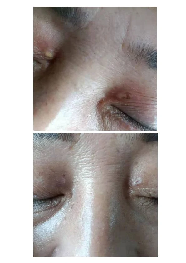 眼周汗管瘤改善对比