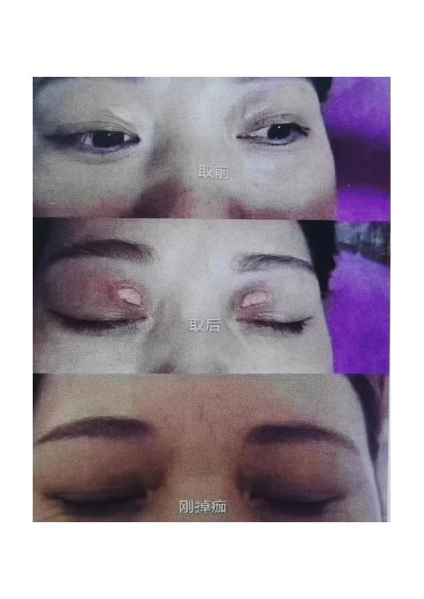 眼周睑黄疣阶段对比