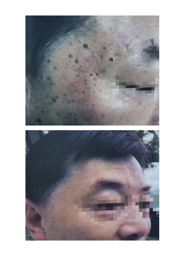 眼周汗管瘤综合改善记录