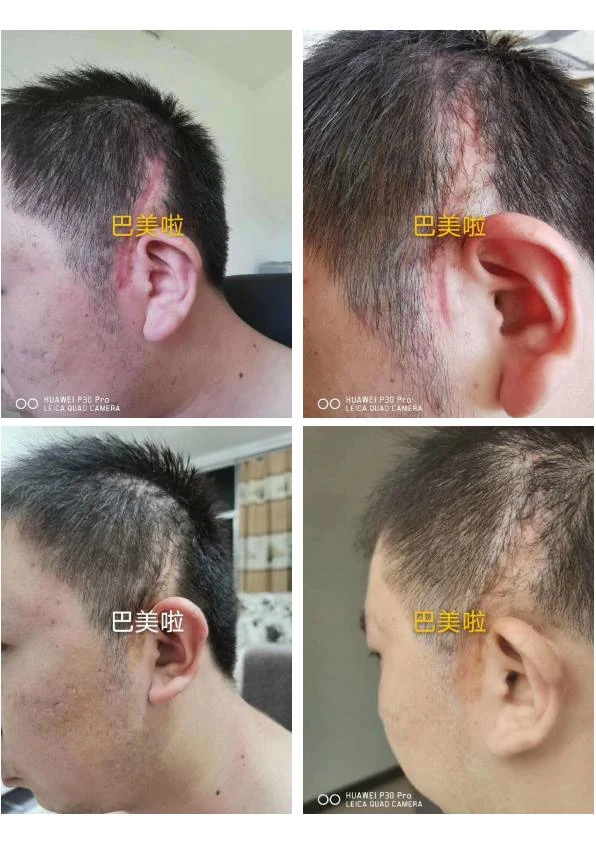 耳部凹陷疤痕改善记录