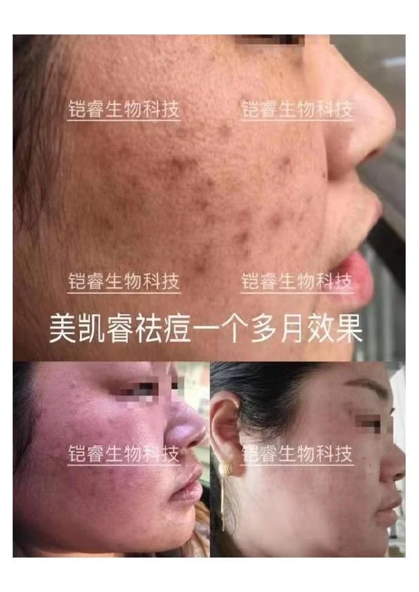 面部痤疮改善阶段记录 07