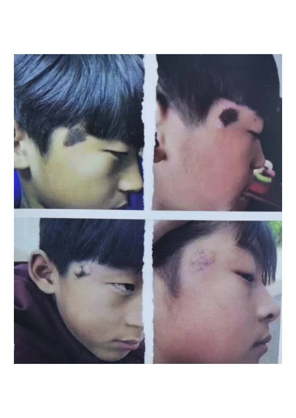 胎记改善阶段记录 04