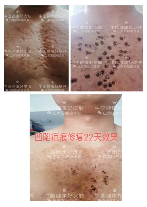 胸腹部凹陷疤痕改善记录