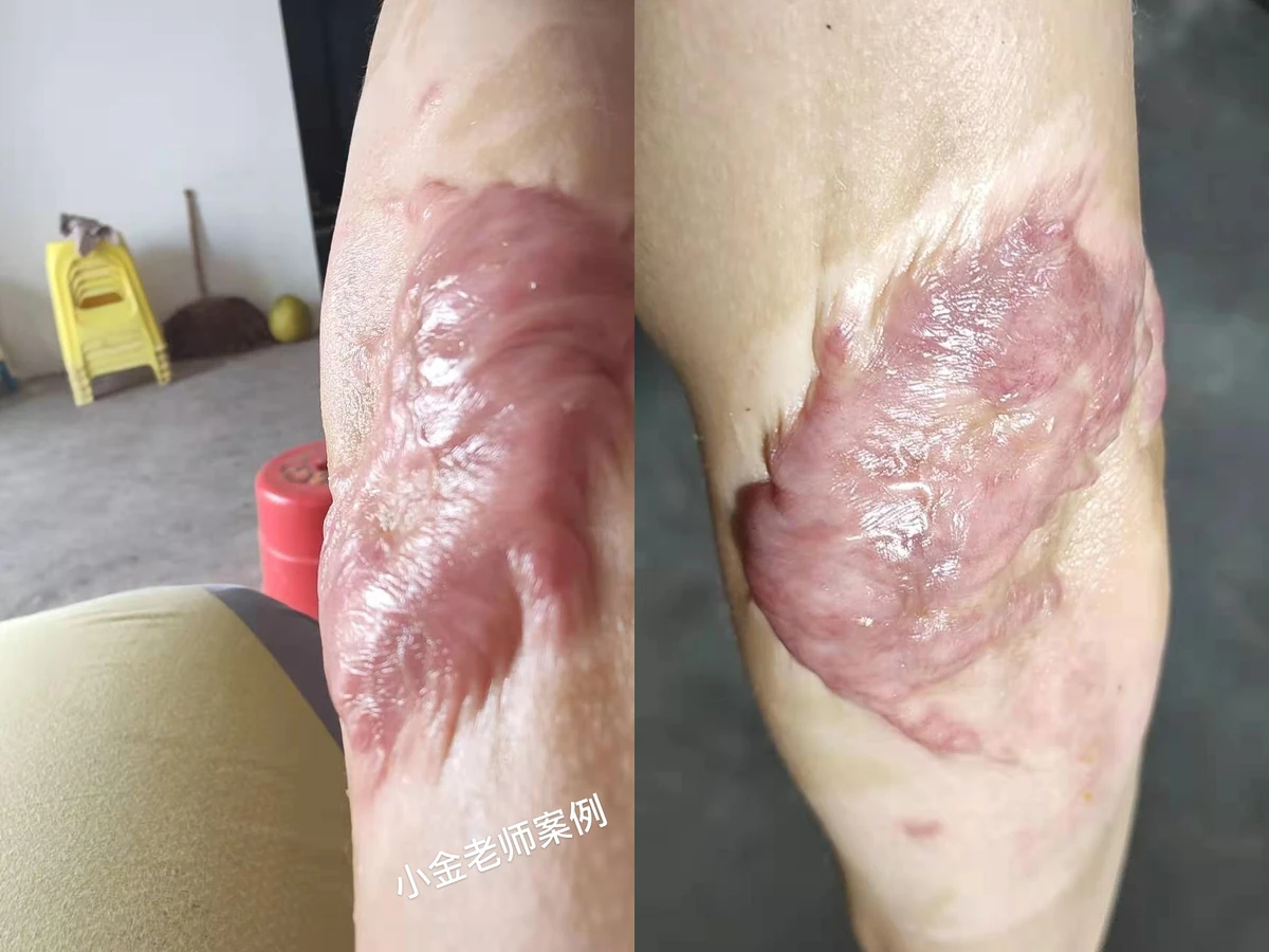 肘部增生疤痕修复对比