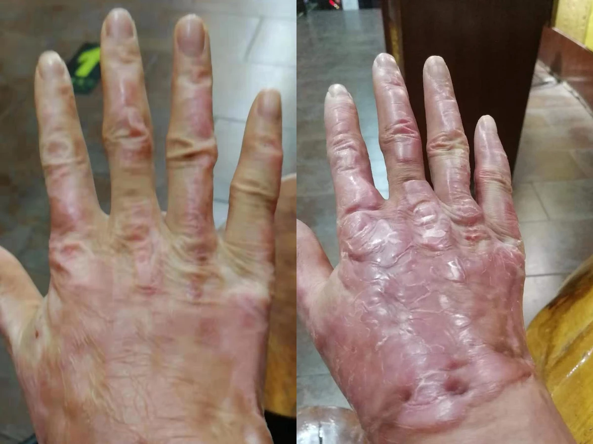 手部烧烫伤疤痕修复对比