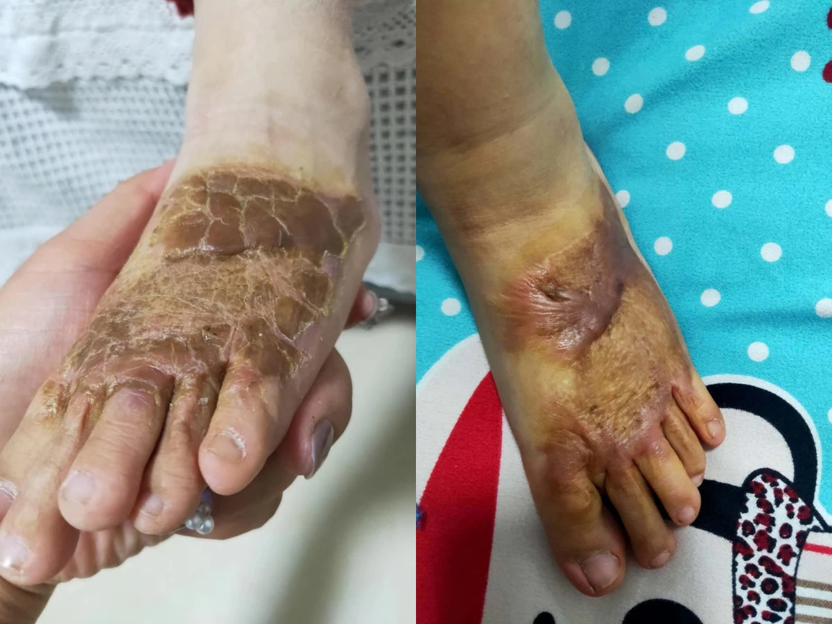 足背烧烫伤疤痕阶段改善
