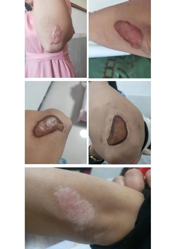 肘部增生疤痕改善对比